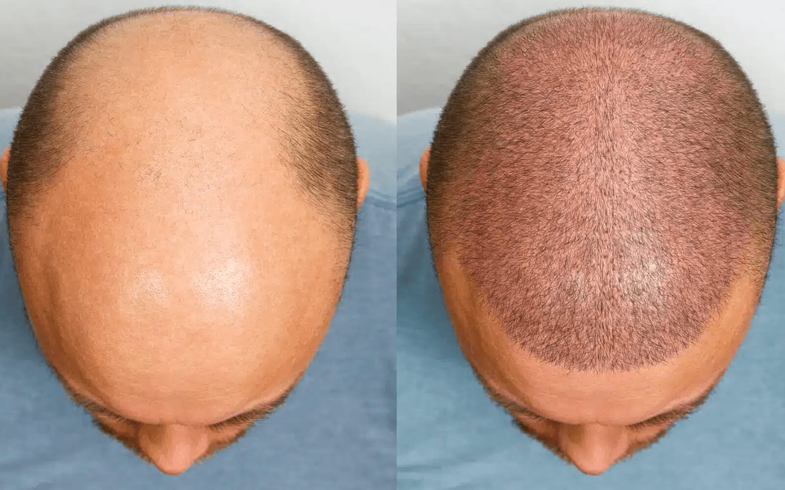 Hair Transplant Turkey Before and After
