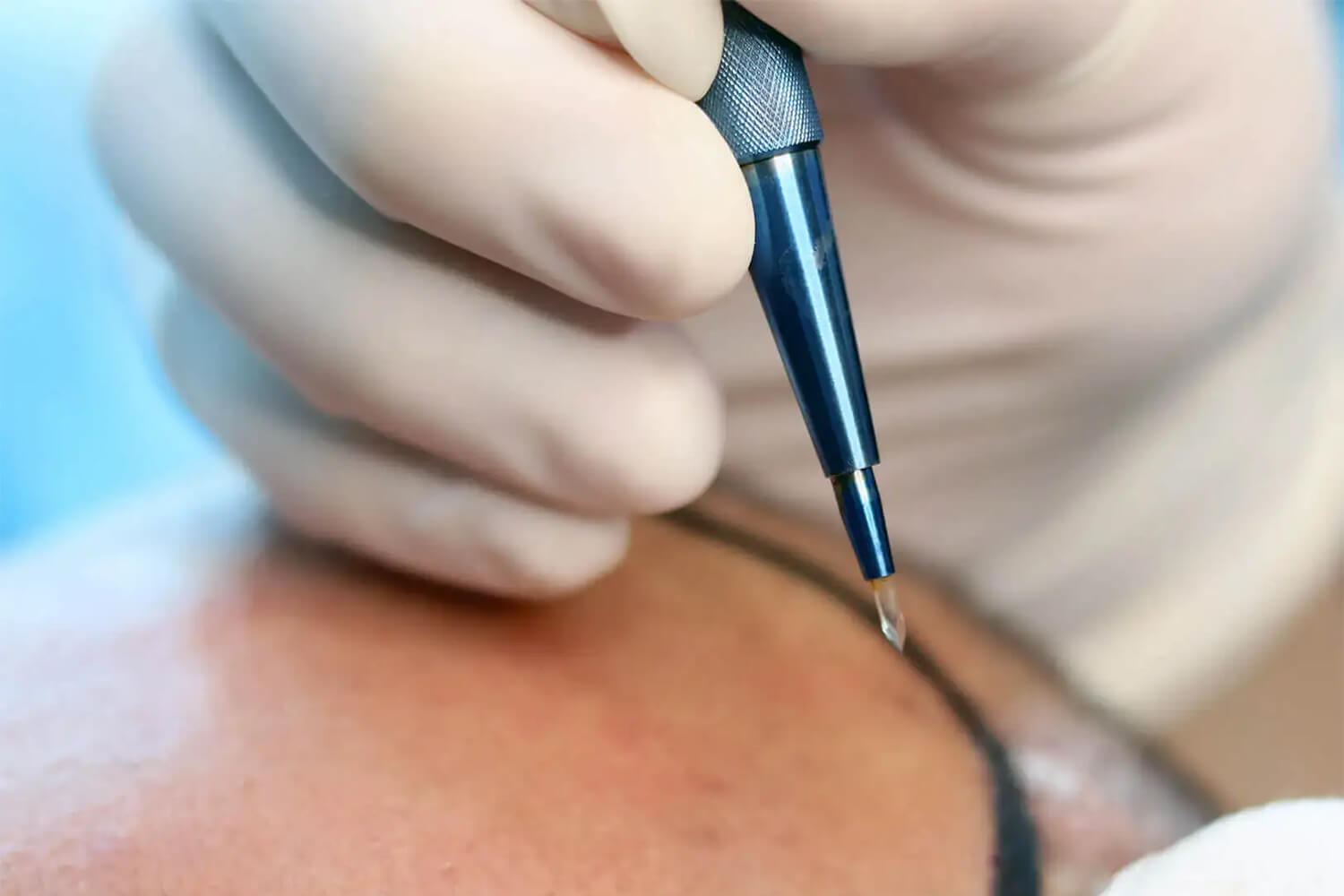 Sapphire FUE Hair Transplant Turkey