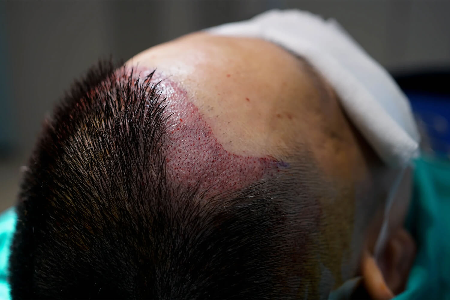 Shaven FUE Hair Transplant