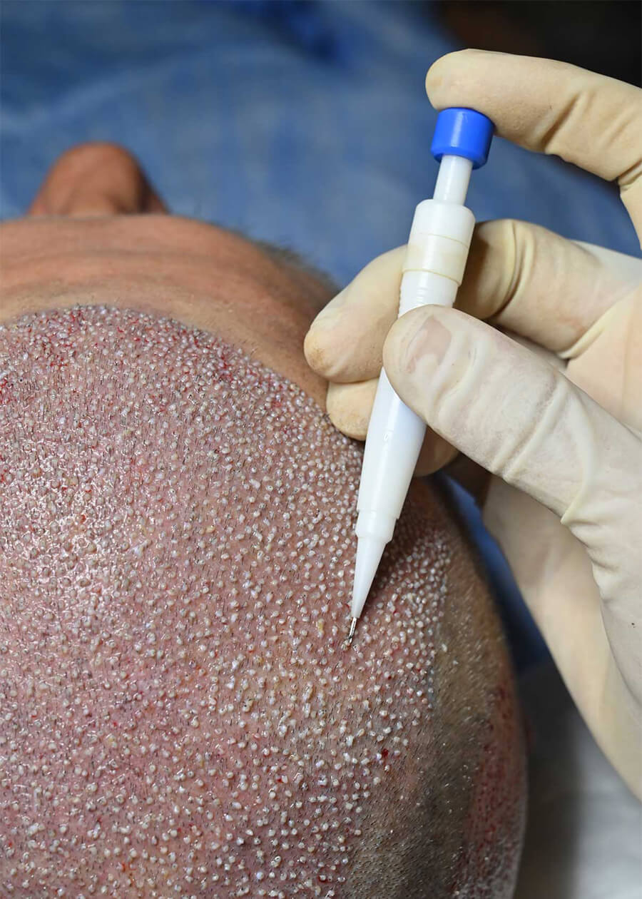 dhi hair transplant turkey