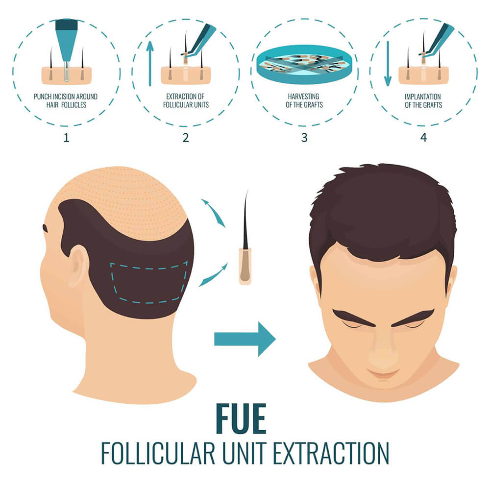 FUE Hair Transplant Turkey