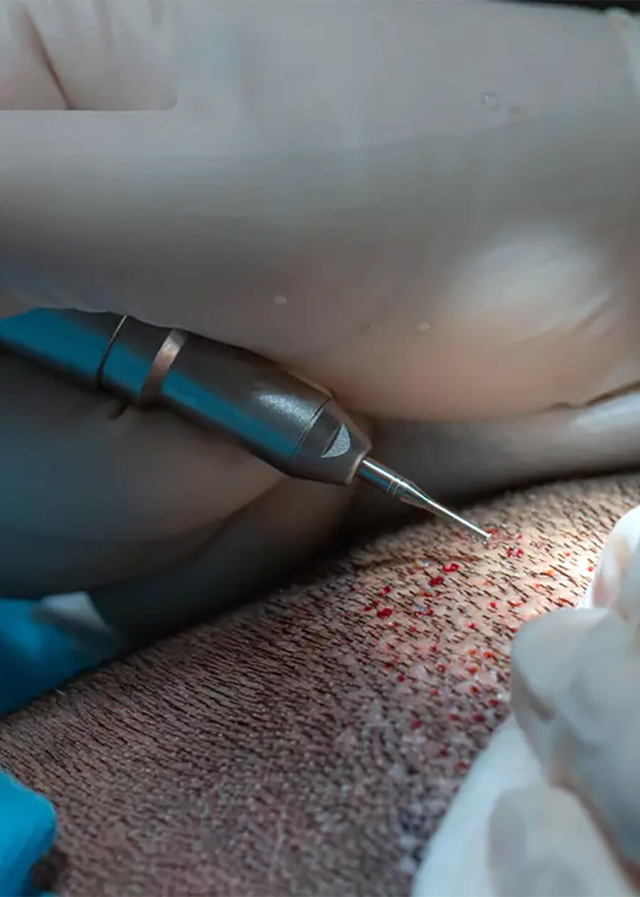 fue hair transplant turkey