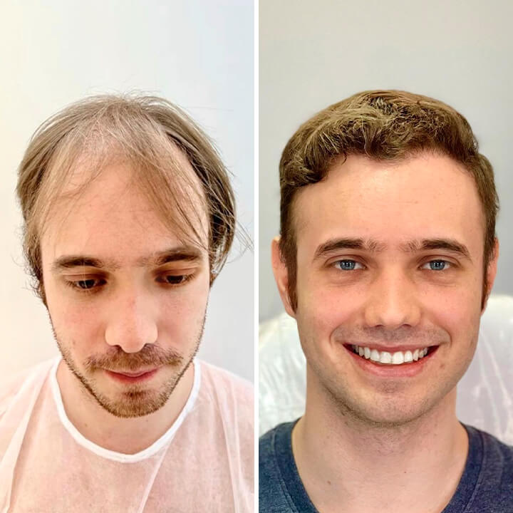 Hair Transplant Turkey Before After
