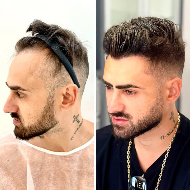 Hair Transplant Turkey Before After