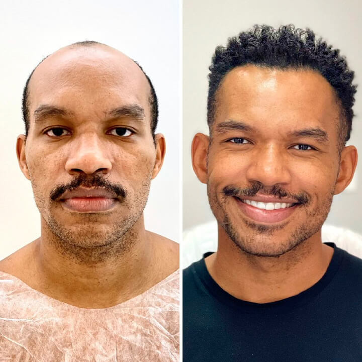 Hair Transplant Turkey Before After