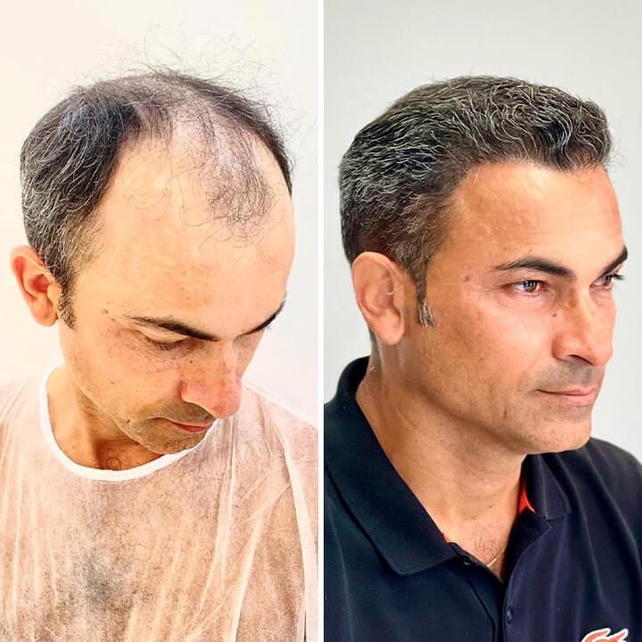 Hair Transplant Turkey Before After