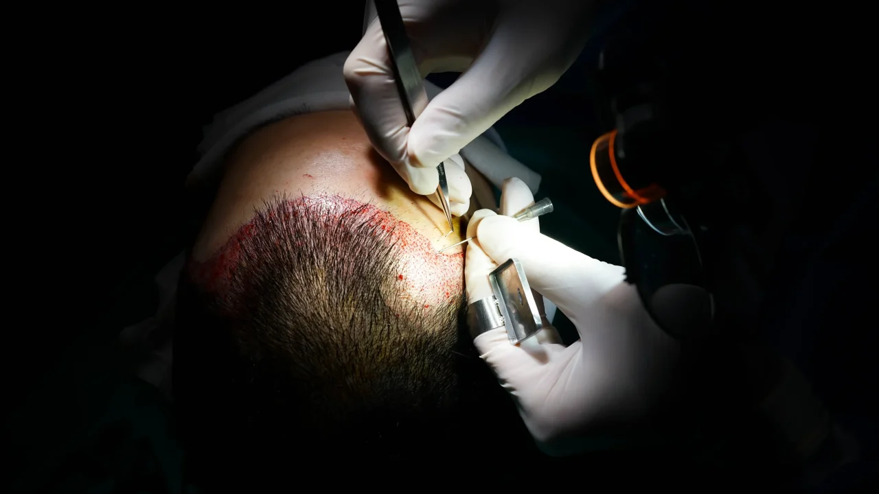 Shaven FUE Hair Transplant Cost Turkey