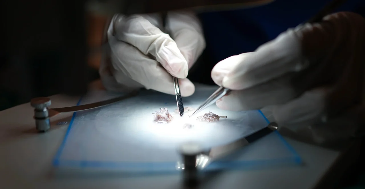 What-is-FUE-Hair-Transplantation